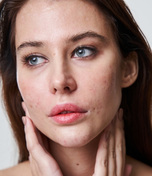 Gesichtsportrait Frauengesicht mit Akne steht für Akne-Behandlung
